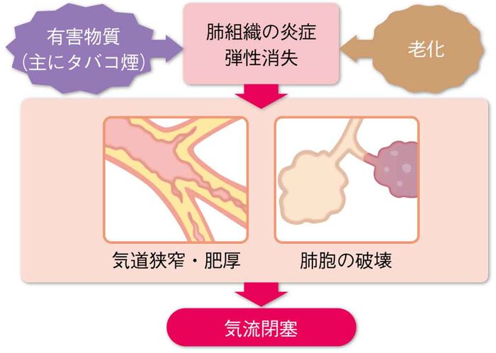 COPDの発症の画像