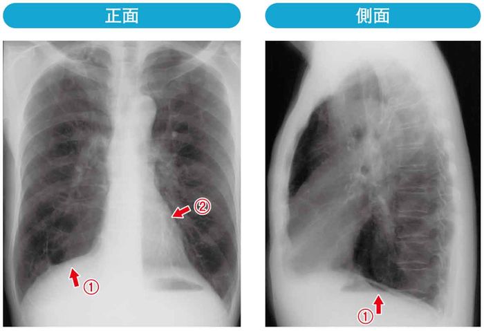 CCOPD患者の胸部単純X線写真の画像