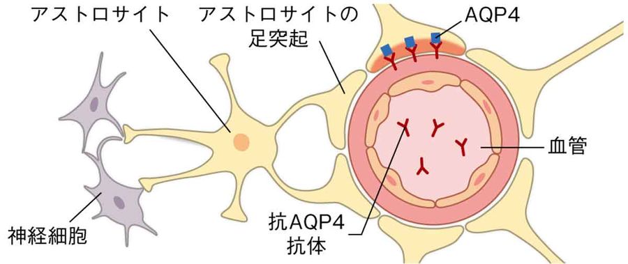 NMOSD発症イメージの画像