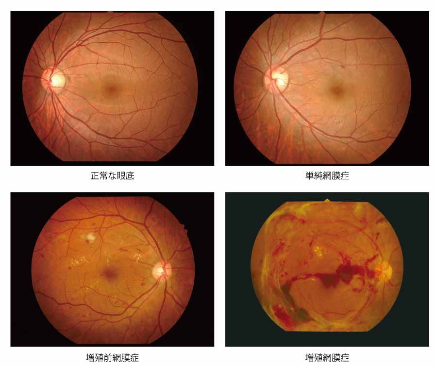 図2 糖尿病網膜症の病期と眼底所見の画像