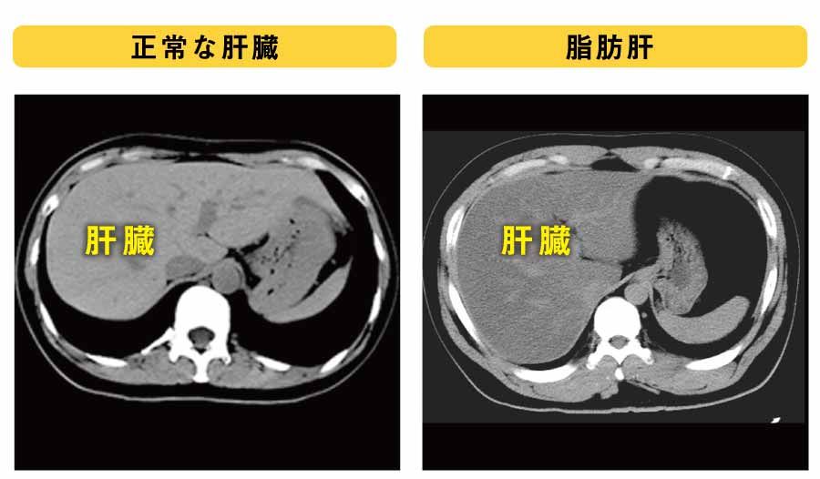 図1 脂肪肝のCT画像の画像