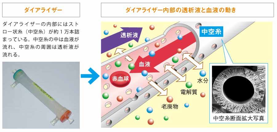 図2 血液透析の仕組みの画像
