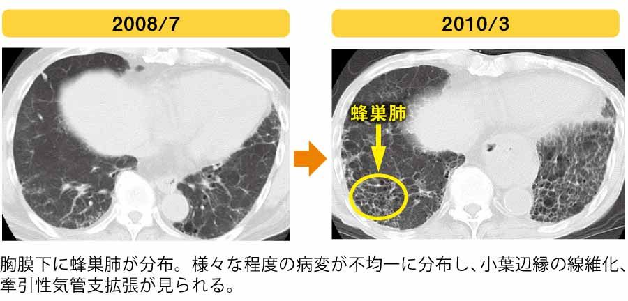 図1 IPFの経過を示す高分解能CT画像の画像