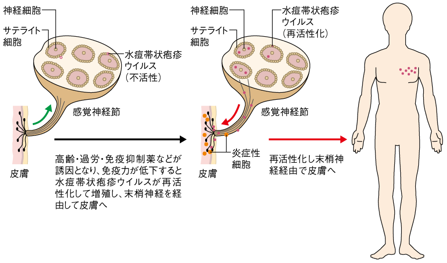 図 帯状疱疹回帰発症の病態の画像