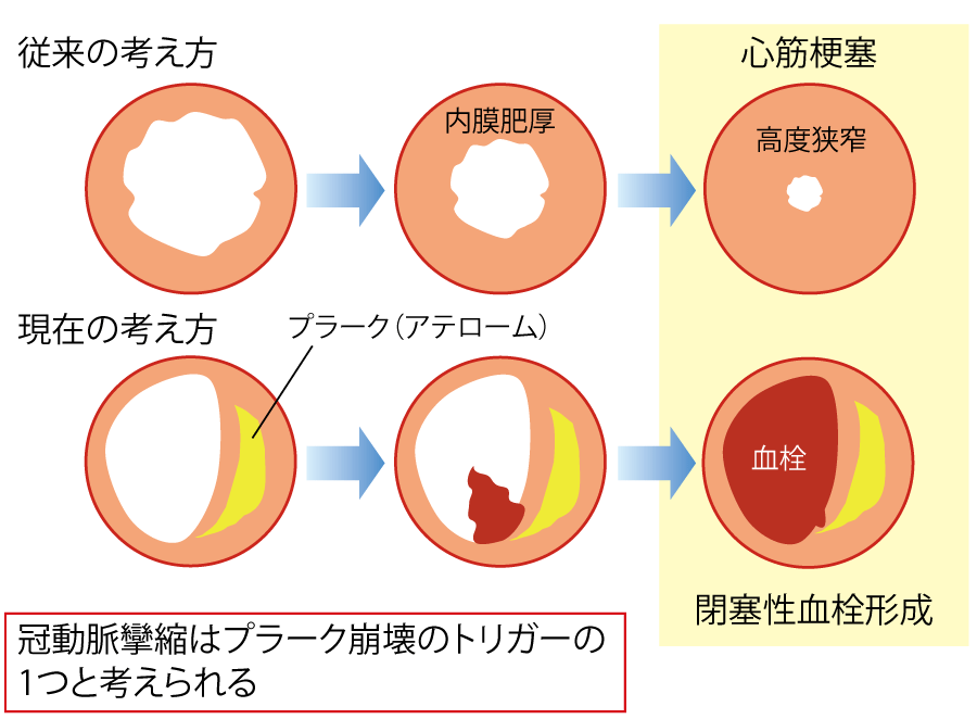 図2 心筋梗塞の発症機序の画像