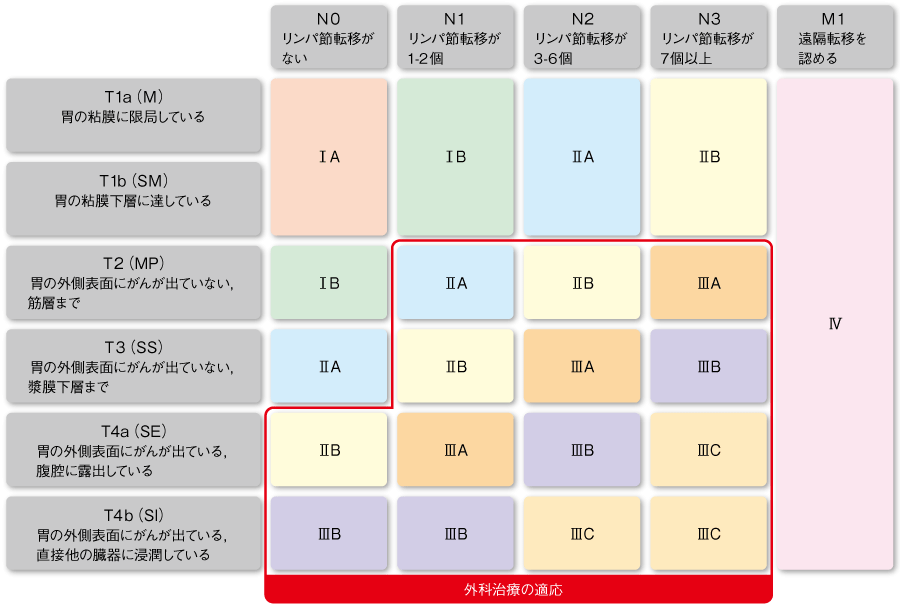 図1 胃がんの進行度・ステージ分類の画像