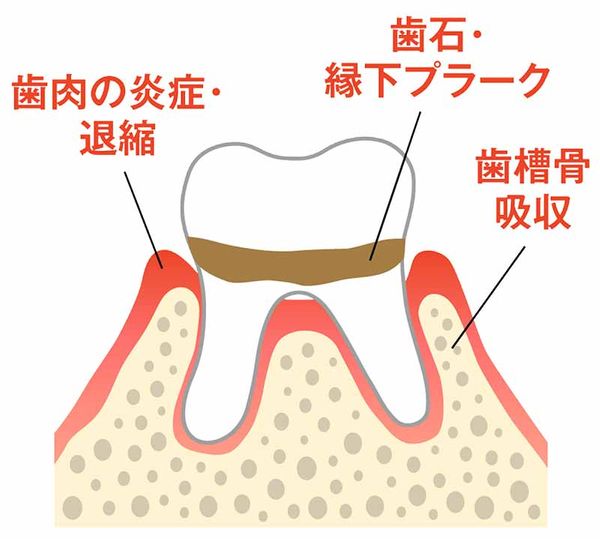 歯周病のメカニズム1の画像