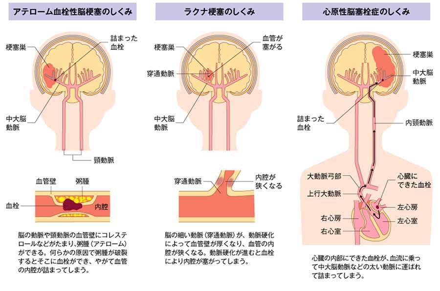 図2 脳梗塞のタイプと梗塞のメカニズムの画像